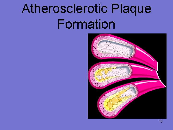 Atherosclerotic Plaque Formation 10 