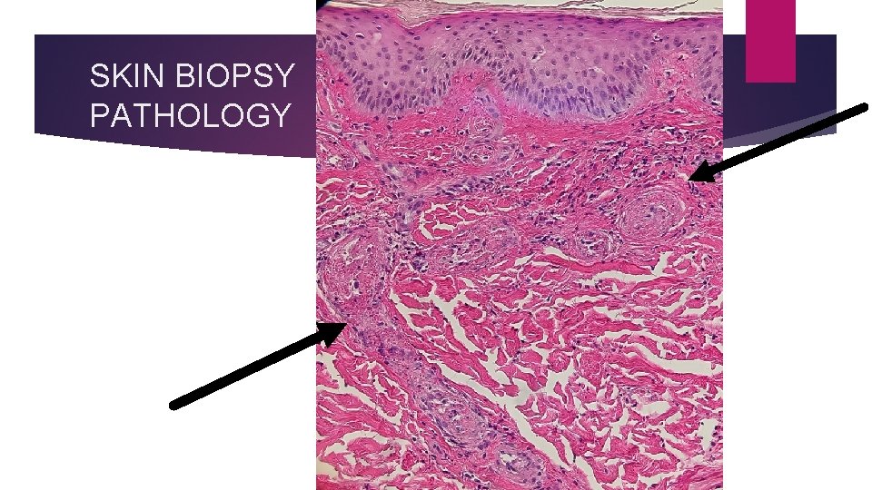 SKIN BIOPSY PATHOLOGY 