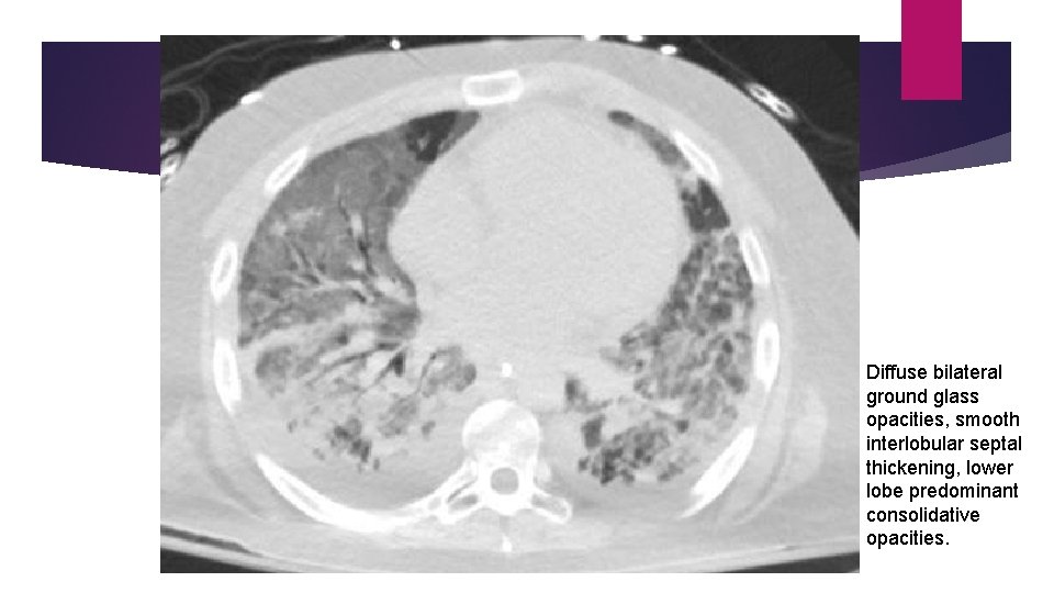 Diffuse bilateral ground glass opacities, smooth interlobular septal thickening, lower lobe predominant consolidative opacities.