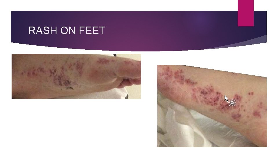 RASH ON FEET 