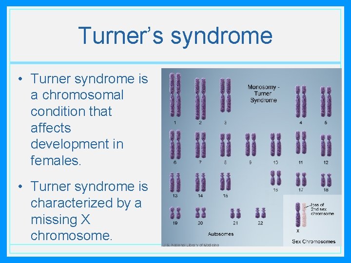 Turner’s syndrome • Turner syndrome is a chromosomal condition that affects development in females.