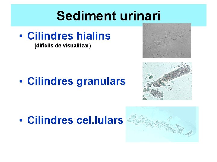 Sediment urinari • Cilindres hialins (difícils de visualitzar) • Cilindres granulars • Cilindres cel.