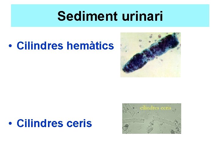 Sediment urinari • Cilindres hemàtics • Cilindres ceris 