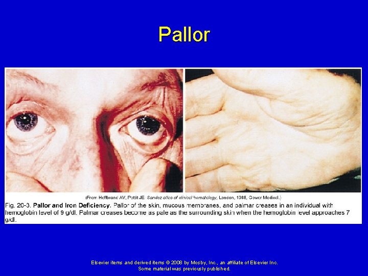 Pallor Elsevier items and derived items © 2008 by Mosby, Inc. , an affiliate