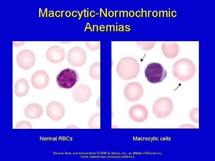 Macrocytic-Normochromic Anemias Normal RBCs Macrocytic cells Elsevier items and derived items © 2008 by