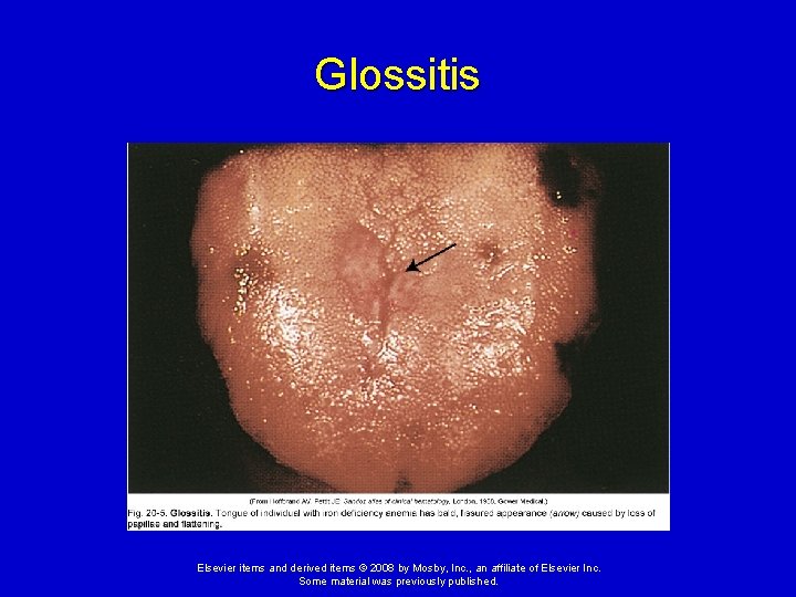 Glossitis Elsevier items and derived items © 2008 by Mosby, Inc. , an affiliate
