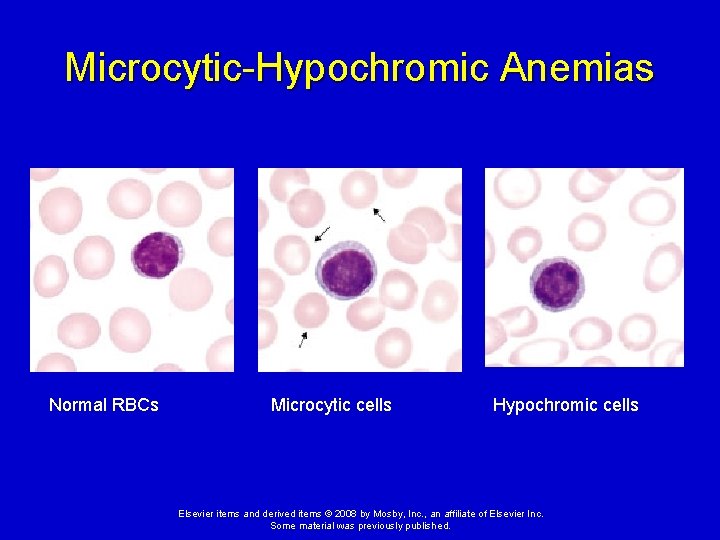 Microcytic-Hypochromic Anemias Normal RBCs Microcytic cells Hypochromic cells Elsevier items and derived items ©