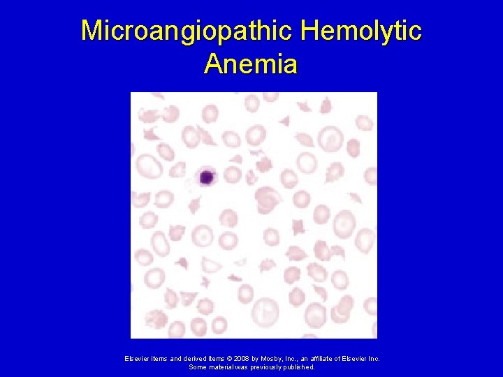 Microangiopathic Hemolytic Anemia Elsevier items and derived items © 2008 by Mosby, Inc. ,