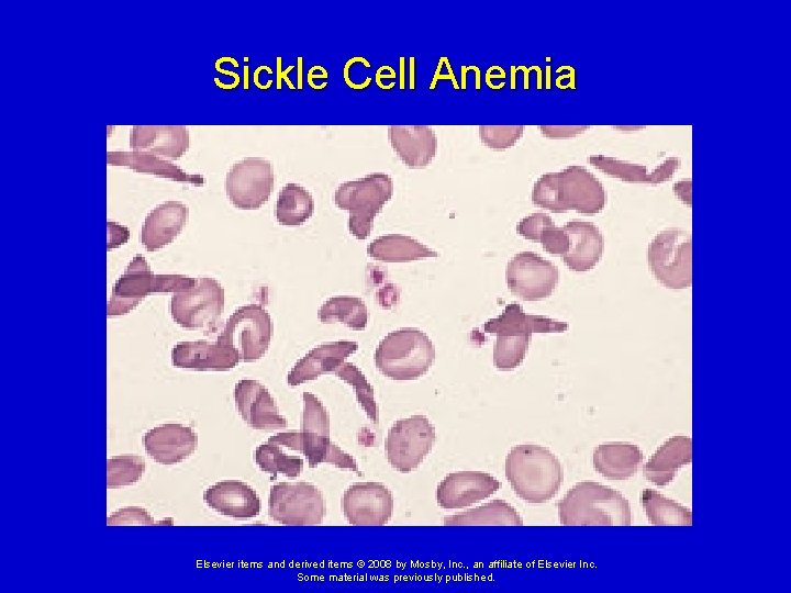 Sickle Cell Anemia Elsevier items and derived items © 2008 by Mosby, Inc. ,