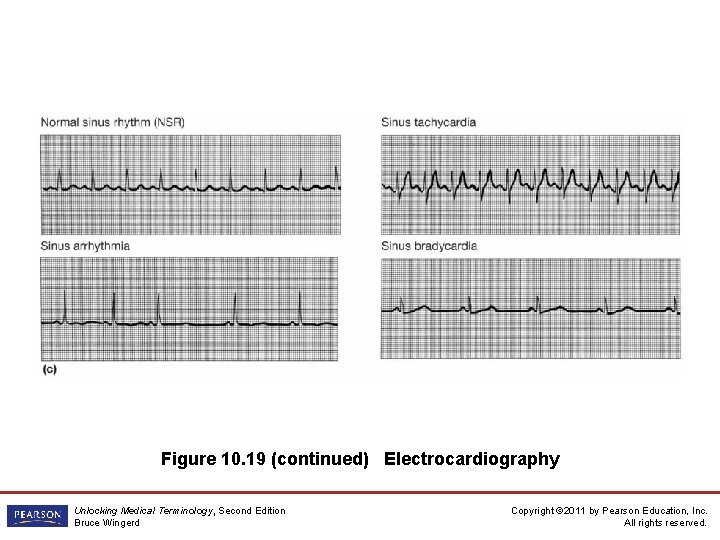 Figure 10. 19 (continued) Electrocardiography Unlocking Medical Terminology, Second Edition Bruce Wingerd Copyright ©