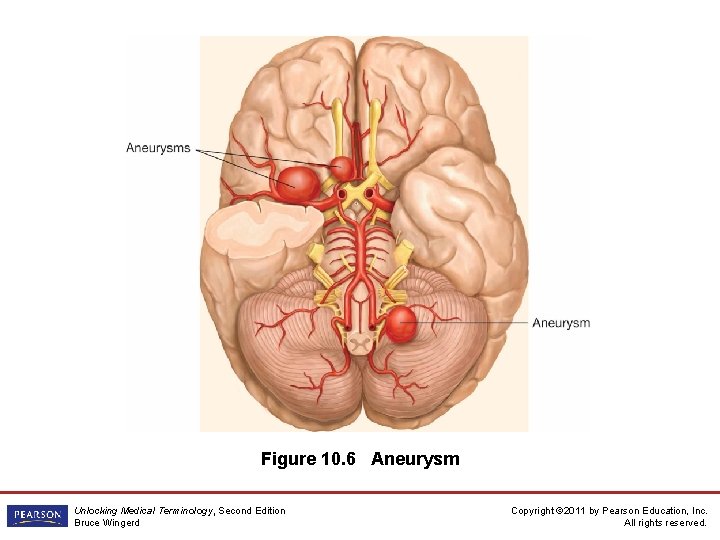 Figure 10. 6 Aneurysm Unlocking Medical Terminology, Second Edition Bruce Wingerd Copyright © 2011