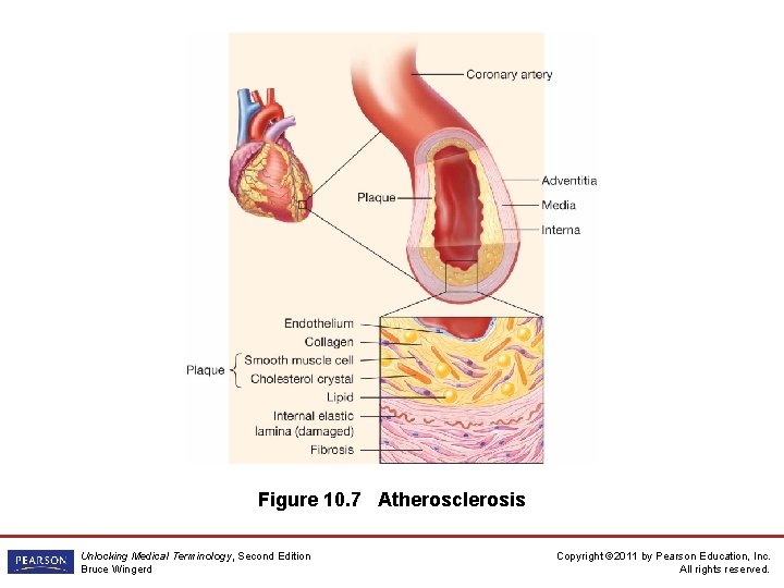 Figure 10. 7 Atherosclerosis Unlocking Medical Terminology, Second Edition Bruce Wingerd Copyright © 2011