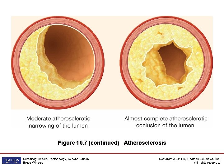 Figure 10. 7 (continued) Atherosclerosis Unlocking Medical Terminology, Second Edition Bruce Wingerd Copyright ©