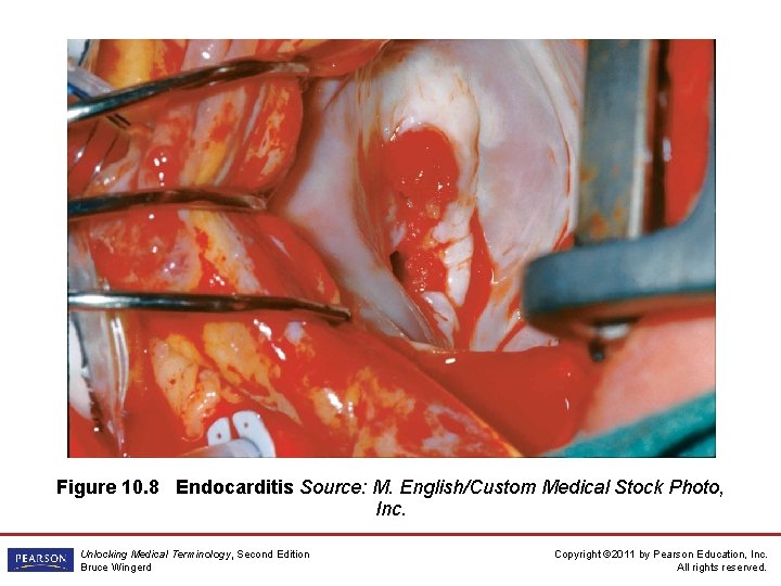 Figure 10. 8 Endocarditis Source: M. English/Custom Medical Stock Photo, Inc. Unlocking Medical Terminology,
