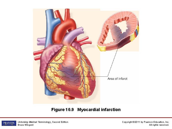 Figure 10. 9 Myocardial infarction Unlocking Medical Terminology, Second Edition Bruce Wingerd Copyright ©