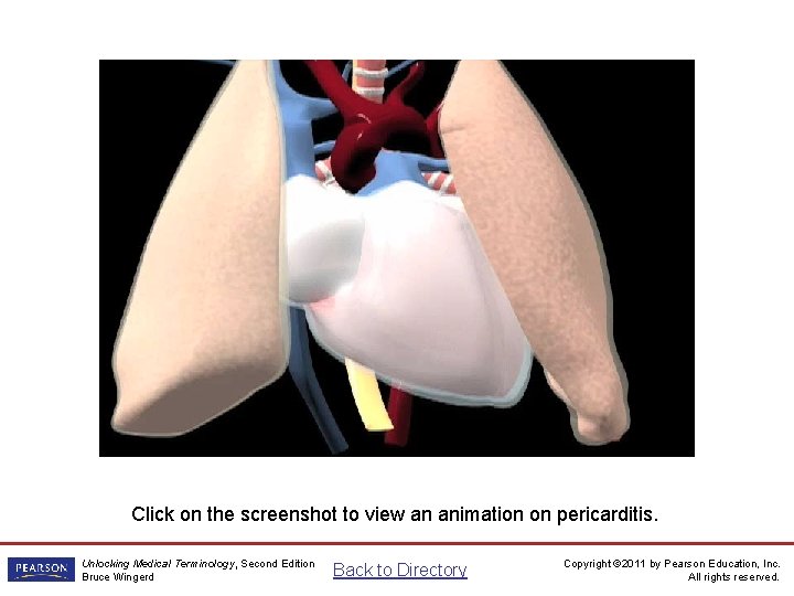 Pericarditis Animation Click on the screenshot to view an animation on pericarditis. Unlocking Medical