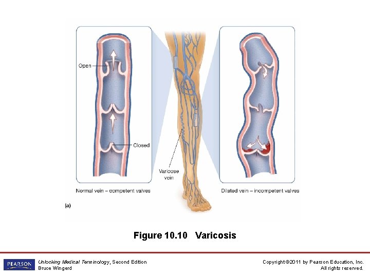 Figure 10. 10 Varicosis Unlocking Medical Terminology, Second Edition Bruce Wingerd Copyright © 2011