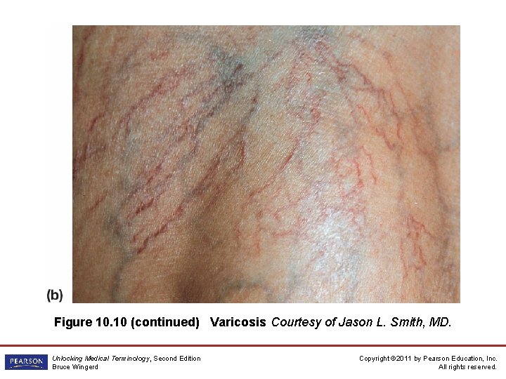 Figure 10. 10 (continued) Varicosis Courtesy of Jason L. Smith, MD. Unlocking Medical Terminology,