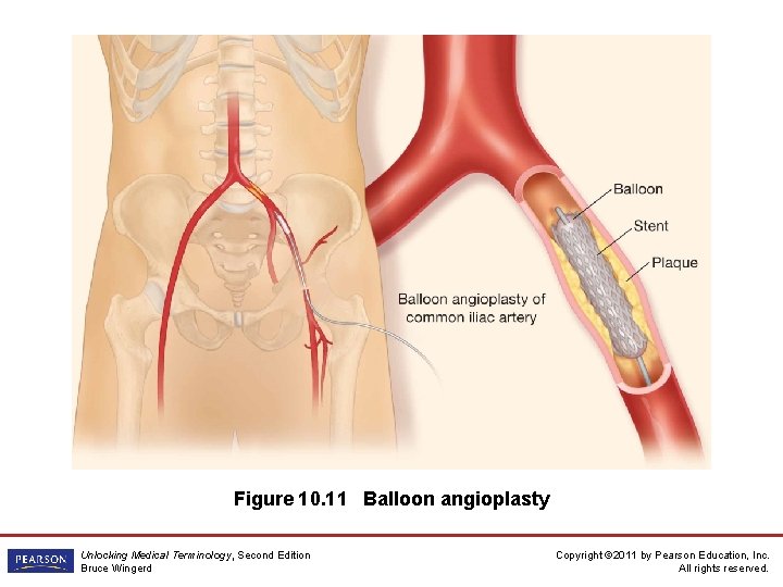 Figure 10. 11 Balloon angioplasty Unlocking Medical Terminology, Second Edition Bruce Wingerd Copyright ©