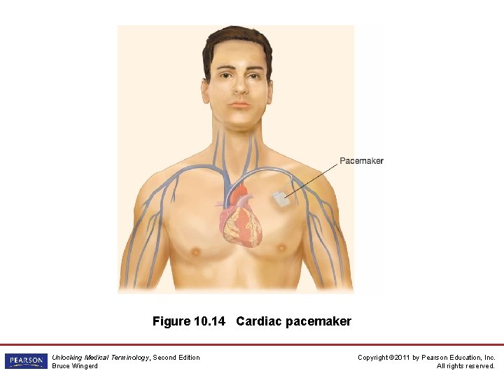 Figure 10. 14 Cardiac pacemaker Unlocking Medical Terminology, Second Edition Bruce Wingerd Copyright ©