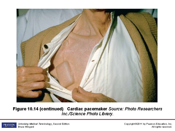 Figure 10. 14 (continued) Cardiac pacemaker Source: Photo Researchers Inc. /Science Photo Library. Unlocking