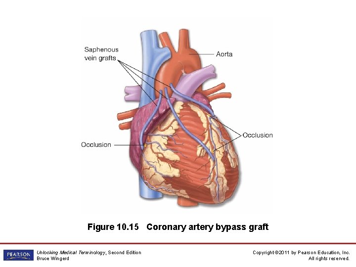 Figure 10. 15 Coronary artery bypass graft Unlocking Medical Terminology, Second Edition Bruce Wingerd