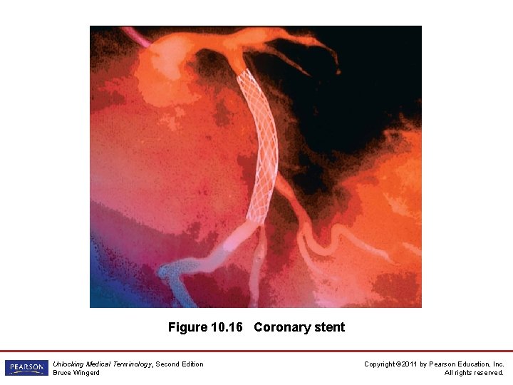 Figure 10. 16 Coronary stent Unlocking Medical Terminology, Second Edition Bruce Wingerd Copyright ©