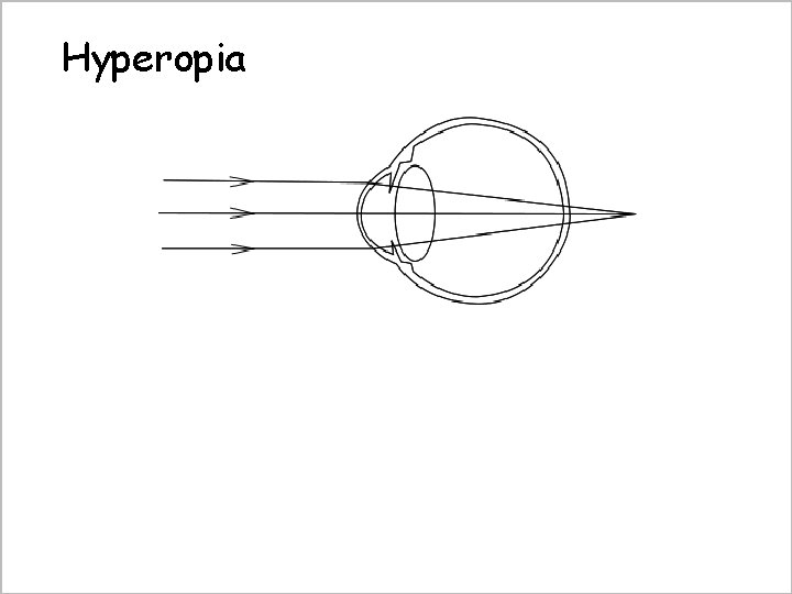 Hyperopia Convex lens for correction 