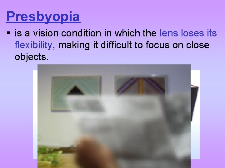 Presbyopia § is a vision condition in which the lens loses its flexibility, making