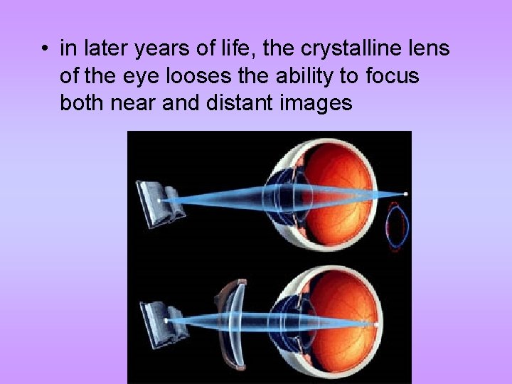  • in later years of life, the crystalline lens of the eye looses