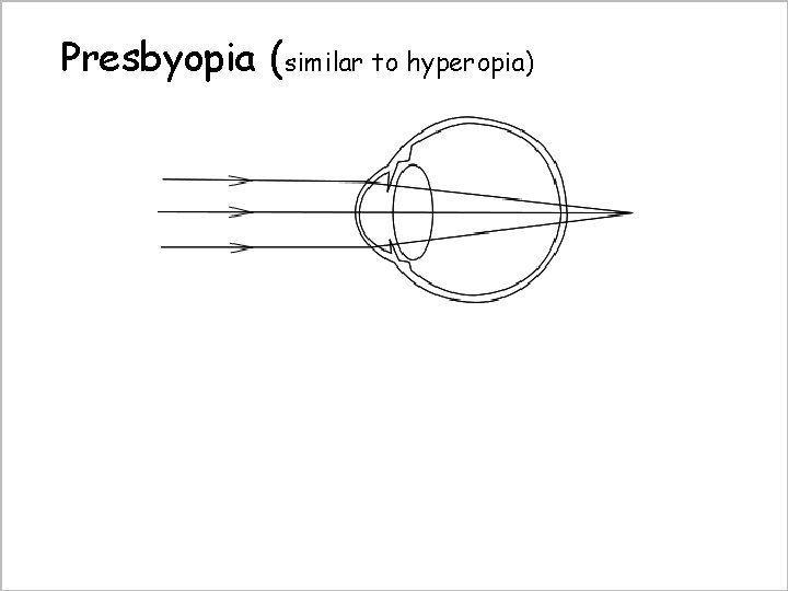 Presbyopia (similar to hyperopia) Convex lens for correction 