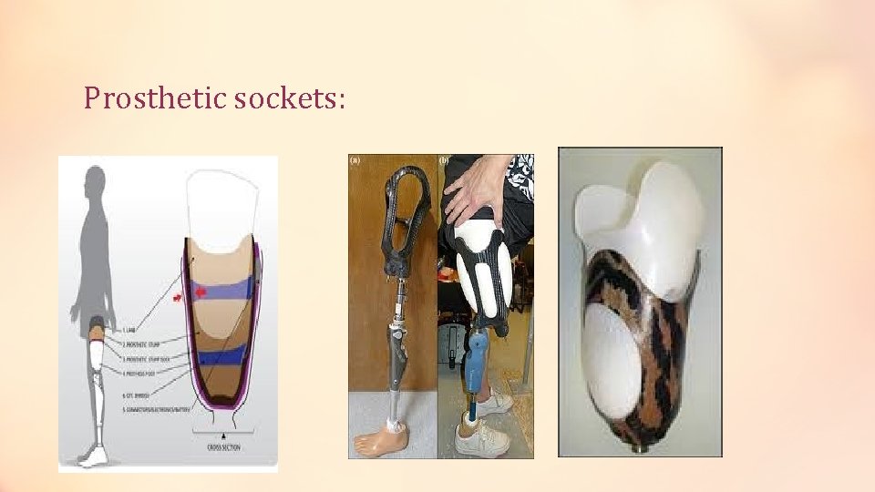 Prosthetic sockets: 