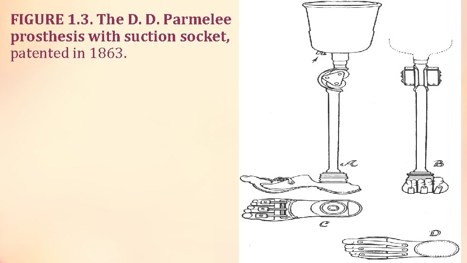 FIGURE 1. 3. The D. D. Parmelee prosthesis with suction socket, patented in 1863.