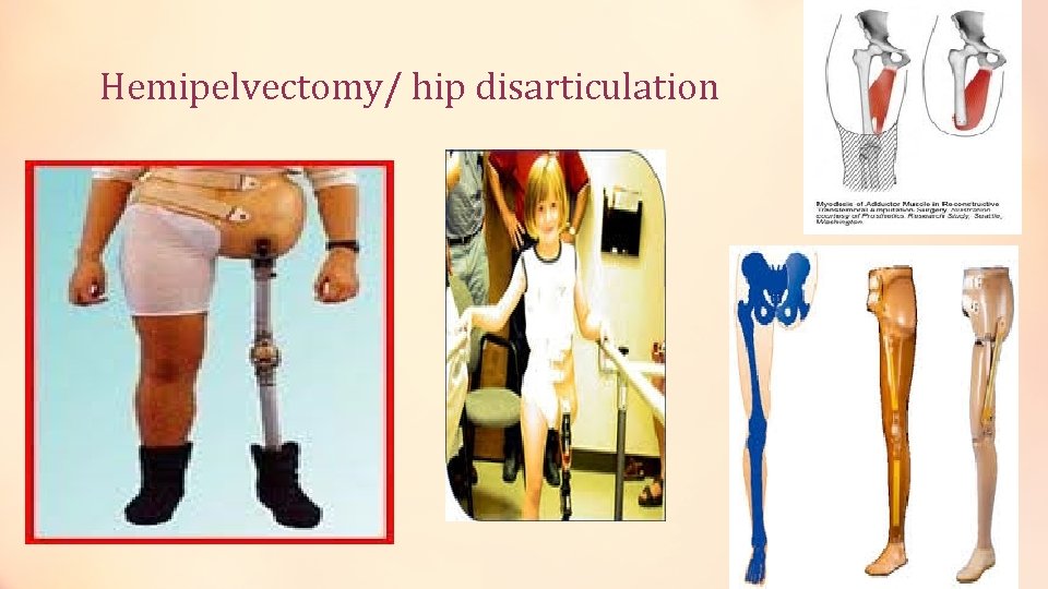 Hemipelvectomy/ hip disarticulation 