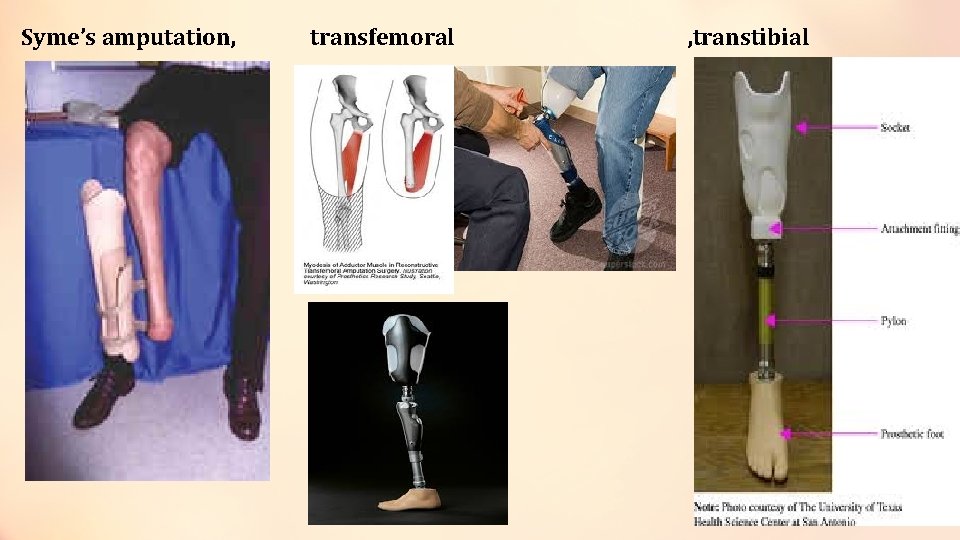 Syme’s amputation, transfemoral , transtibial 