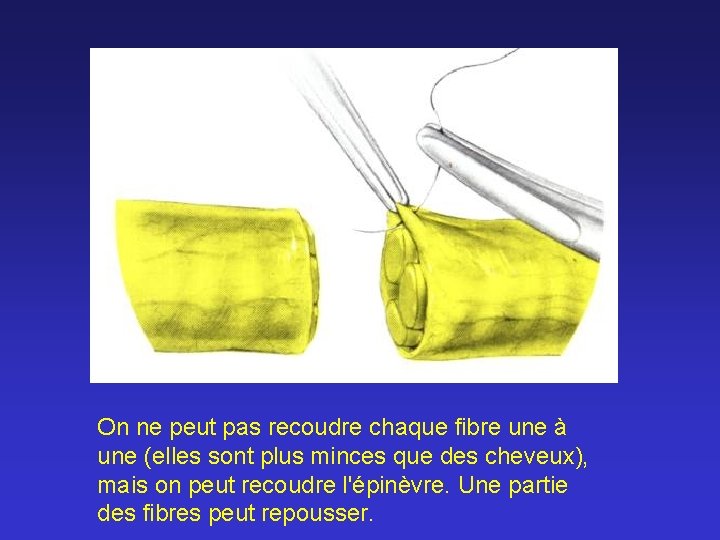 On ne peut pas recoudre chaque fibre une à une (elles sont plus minces