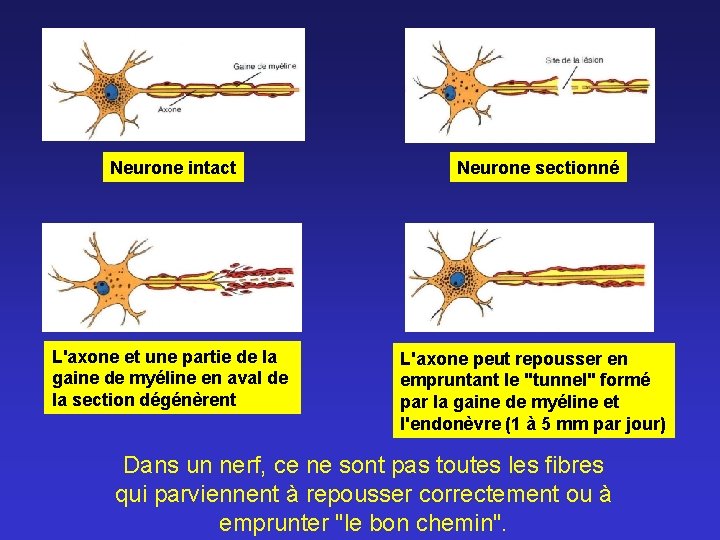 Neurone intact Neurone sectionné L'axone et une partie de la gaine de myéline en