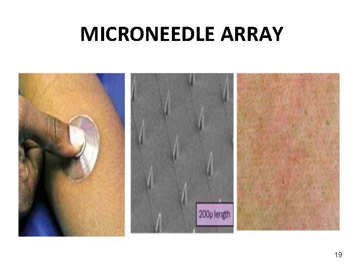 Microarray Needle Pharmaceutics 2 3 32 Unit 4 Transdermal drug