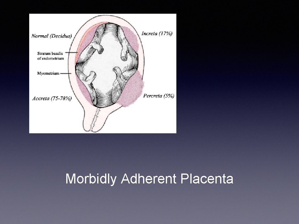 Morbidly Adherent Placenta 