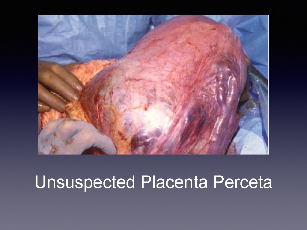 Unsuspected Placenta Perceta 