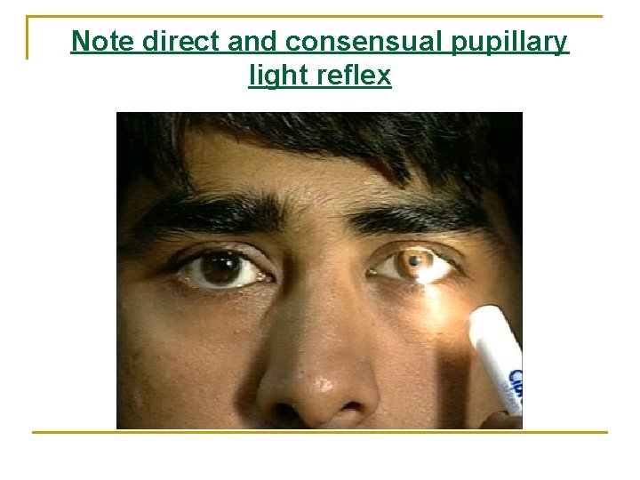 Note direct and consensual pupillary light reflex Note direct and consensual pupillary light reflex