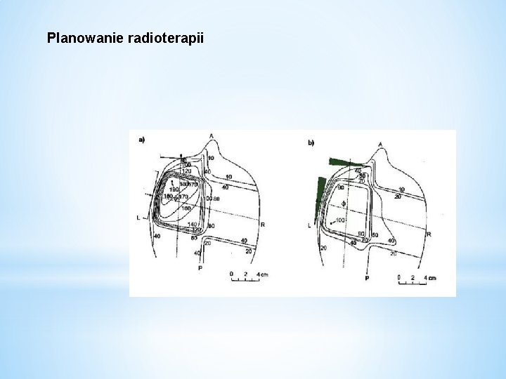 Planowanie radioterapii 