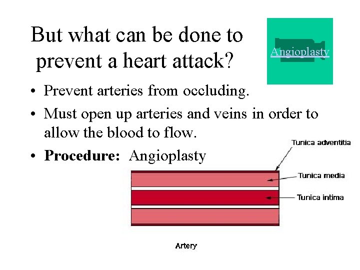 But what can be done to prevent a heart attack? Angioplasty • Prevent arteries