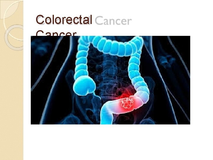 Colorectal Cancer 
