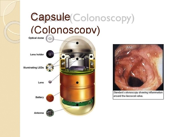 Capsule (Colonoscopy) 