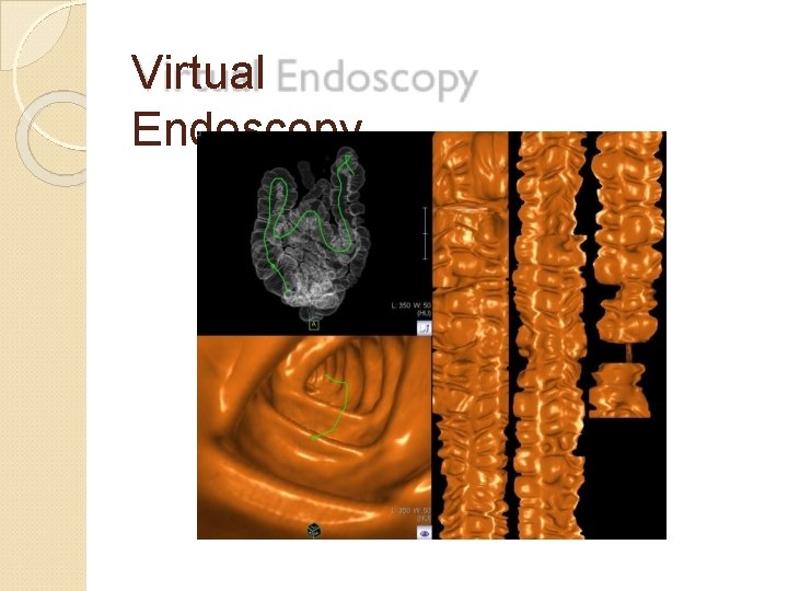 Virtual Endoscopy 