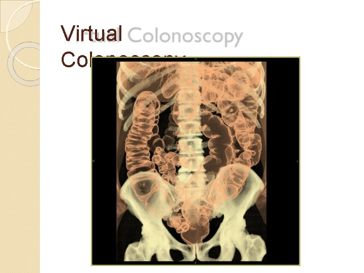 Virtual Colonoscopy 