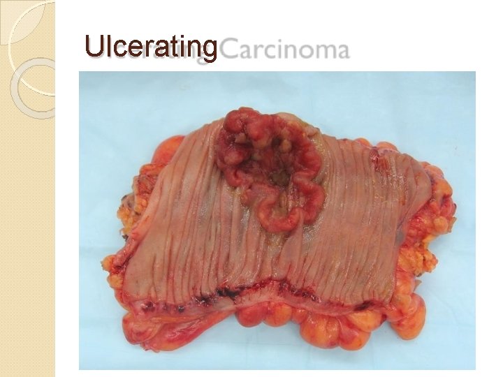 Ulcerating Carcinoma 