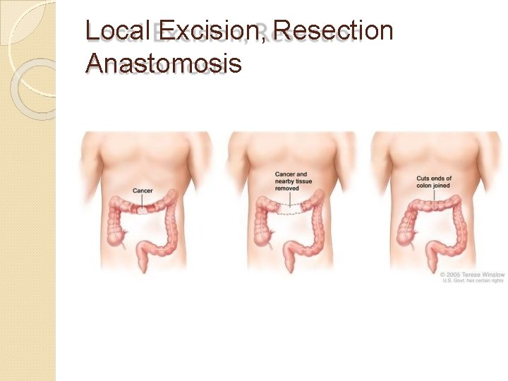 Local Excision, Resection Anastomosis 