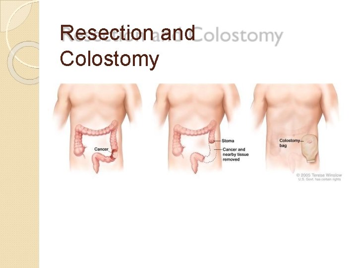 Resection and Colostomy 